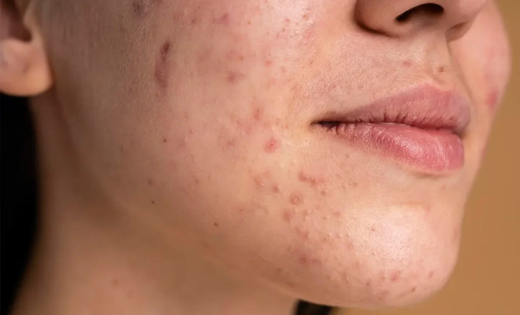 Acne: Comprendere, Prevenire e Trattare con la Linea Pure di Yougen Skincare