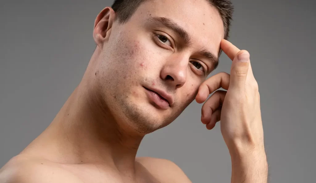 In conclusione l'acne...
La tua skincare con la Linea Pure può aiutarti.