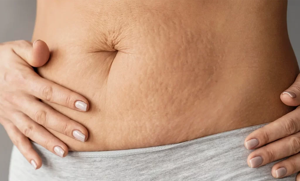 Le Smagliature del Corpo: come combatterle con i prodotti giusti